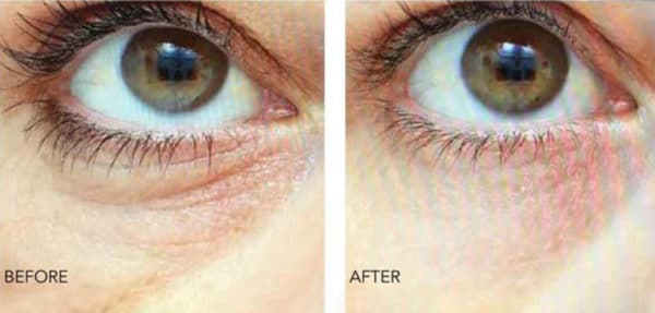 Eyelid-Before-After