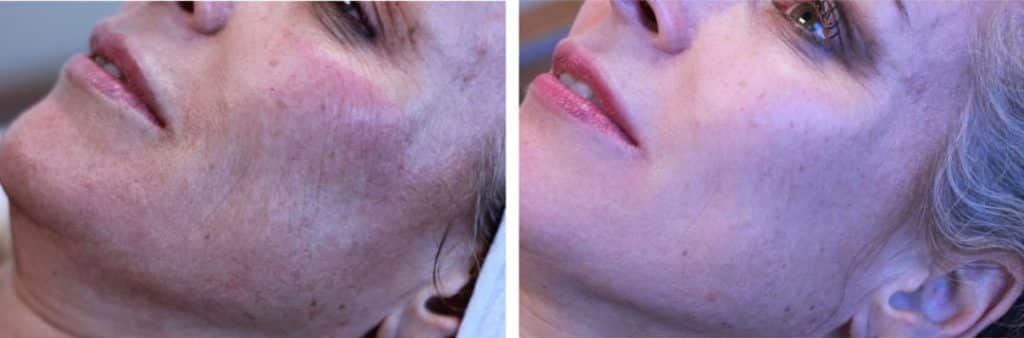 V2 Beauty Booster Full-Face-Before After