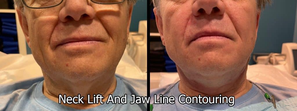 Thermage Neck Lift and jaw line Contouring