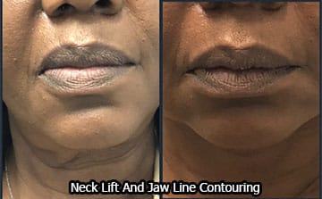Thermage Neck Lift and Jaw Line