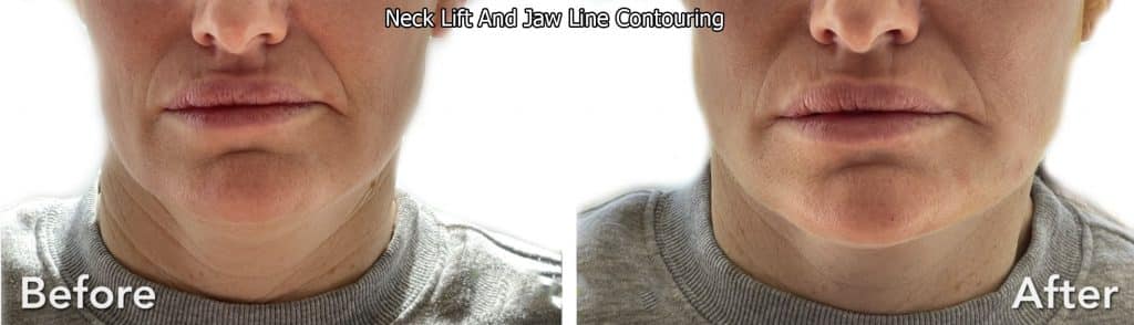 neck lift and Jaw Line Contouring