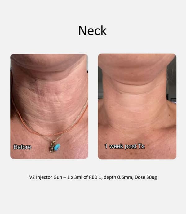 Neck-before-after-img