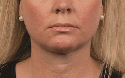 Suzanne-Kilmer-Double-chin-after-12-weeks-img