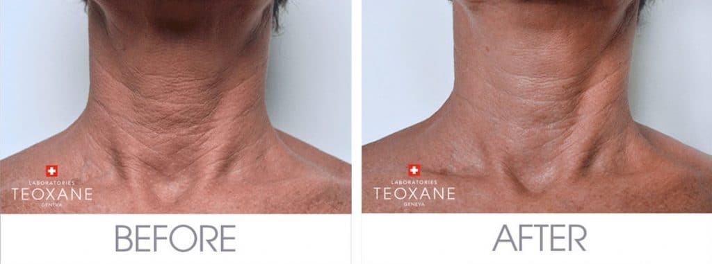 Teoxane-R1-Beauty-Booster