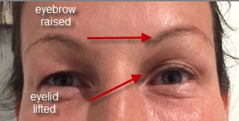 Thermage lid brow lift