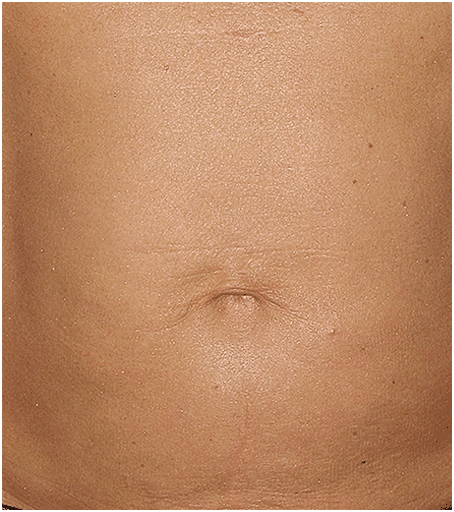 tummy after Thermage