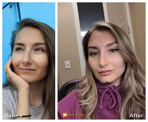 Face Fillers Before and After
