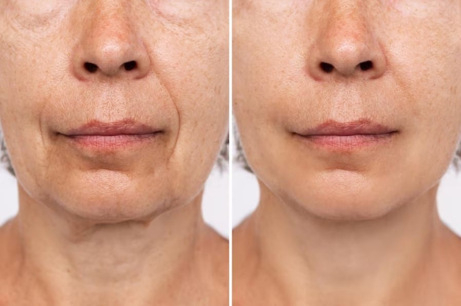 Botox Facials Before and After