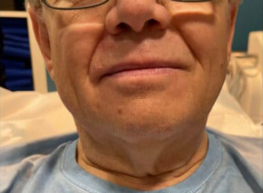 Thread-Lift-Neck1-before