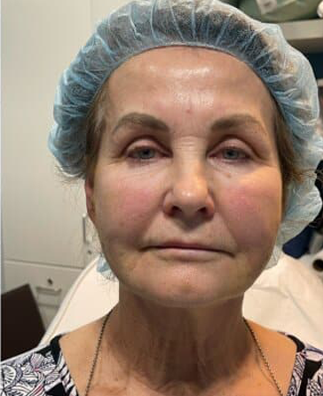 Thread-Lift-Neck2-after