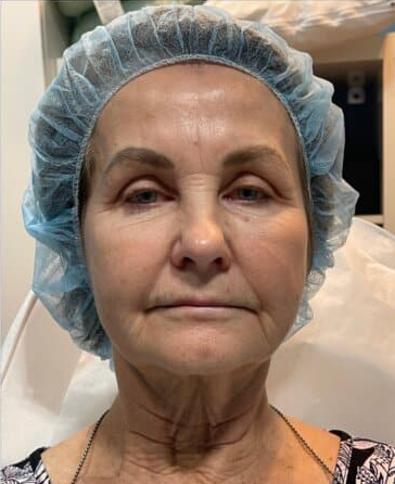 Thread-Lift-Neck2-before